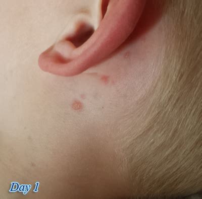 Chicken Pox First Spots