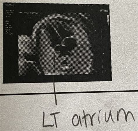 Ob B Quiz Fetal Anatomy Multiple Gestations Flashcards Quizlet