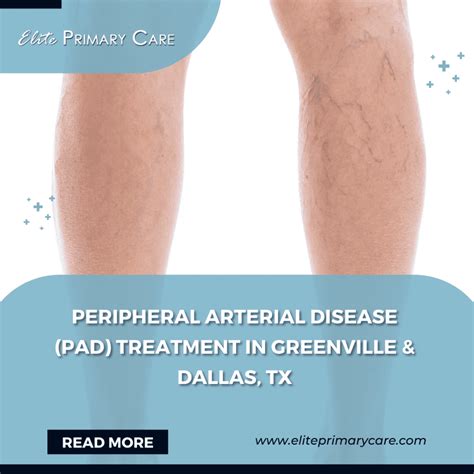 Peripheral Arterial Disease (PAD) Treatment in Greenville & Dallas, TX ...