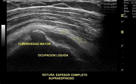 Rotura Del Espesor Completo Del Supraespinoso Ecografía Deportiva