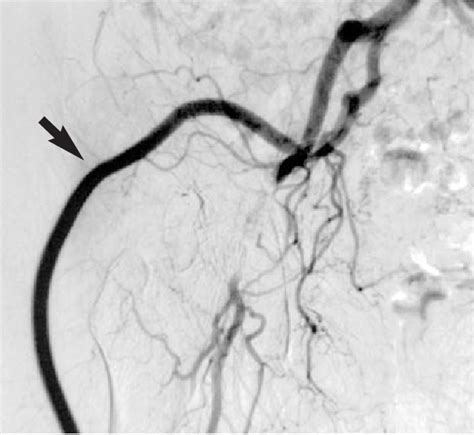 Figure 2 From Management Of Vascular Infection In The Groin Semantic Scholar