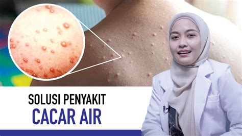 Cacar Air Gejala Penyebab Dan Cara Mengatasinya Kata Dokter YouTube