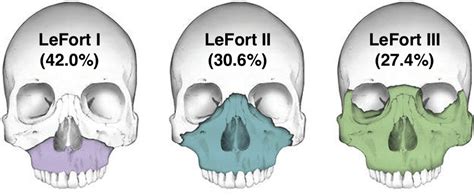 The Characteristics And Cost Of Le Fort Fractures A Review Of