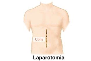 Quando A Cirurgia Por Laparoscopia Mais Indicada Tua Sa De