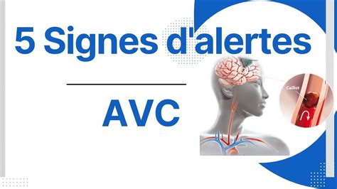 Les Principaux Signes Avant Coureurs Et Symptômes Dun Avc Signes Dalertes Avc Avc