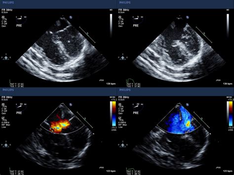 Surgical Repair of Atrioventricular Septal Defect – Dimas Yusuf