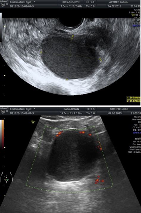 Ginekologia Po Dyplomie Obrazowanie Ultrasonograficzne Endometriozy