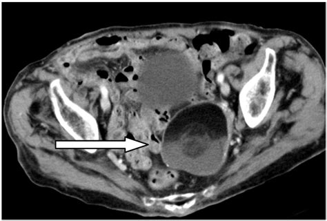 Differential Diagnosis For Female Pelvic Masses Intechopen