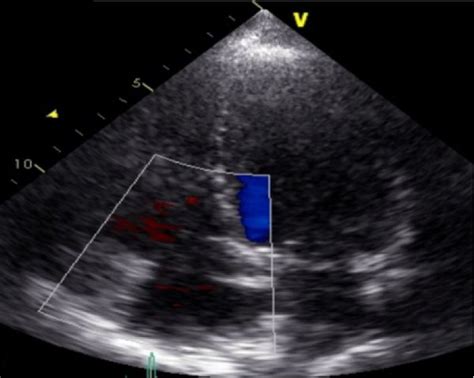 Echocardiography Before A 2 Days B And 3 Months C After