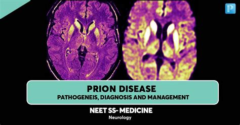 Prion Disease Pathogenesis Diagnosis And Management