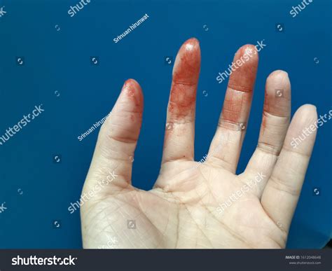 Hand Stain Deep Red Blood Clot Stock Photo 1612048648 | Shutterstock