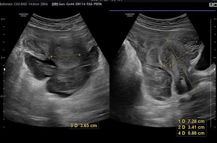 Ruptured Ectopic Pregnancy Ultrasound