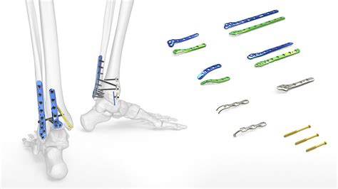 Acumed Ankle Plating System Medical Optical