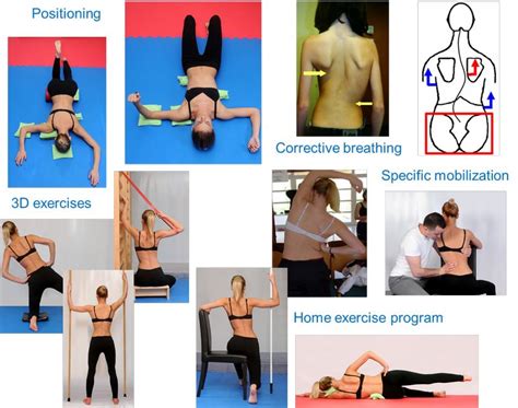 Isst Schroth International Schroth Three Dimensional Scoliosis Therapy