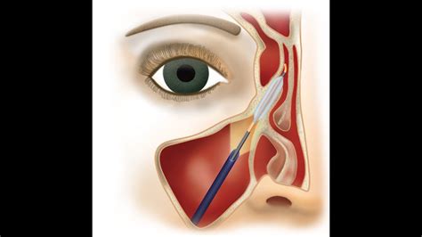 Finess Balloon Sinus Dilation In The Office Under Local Anesthesia