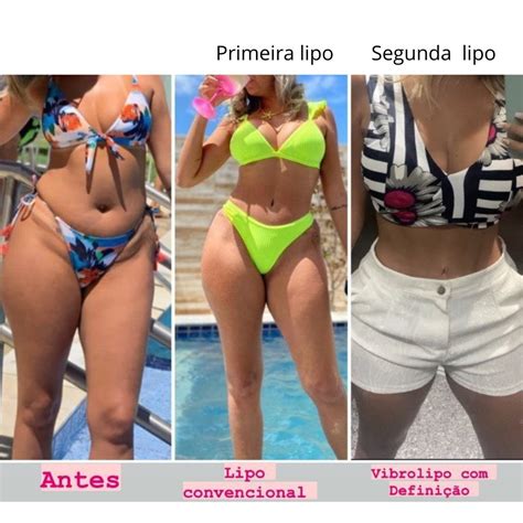 Lipoescultura Abdominoplastia E Pr Tese De Silicone Ml Mentor