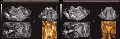 Mullerian Agenesis Ultrasound