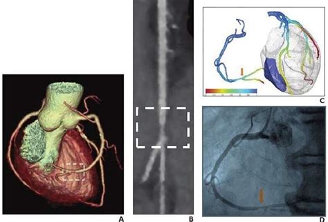 Rapid Onsite FFR CT Algorithm Helps Facilitate Clinical Adoption