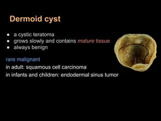 Teratoma | PPT