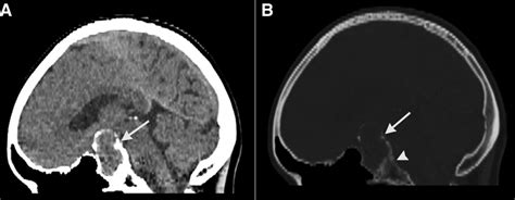 Sagittal Unenhanced Ct Images Brain Window Image A Bone Window