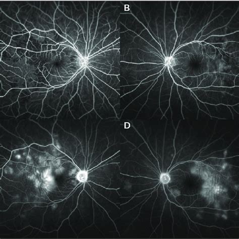 Fluorescein Angiography At 3 Days After The Onset A B Early Phase Download Scientific