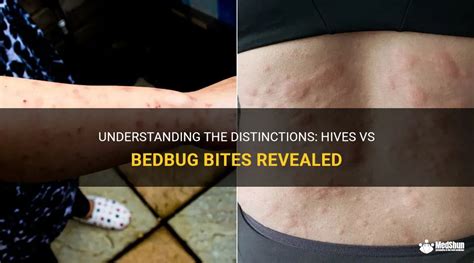 Understanding The Distinctions Hives Vs Bedbug Bites Revealed MedShun