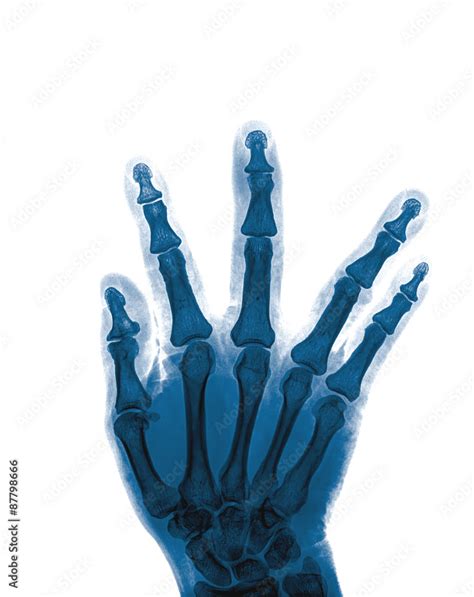 X-ray of hand fractures Stock Photo | Adobe Stock