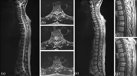 Preoperative T Weighted Mri Showing The Intramedullary Ependymoma