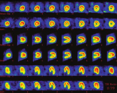 The Dipyridamole Mtc Mibi Myocardial Perfusion Gated Spect Imaging