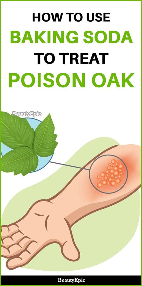 How To Use Baking Soda For Poison Oak Poison Oak Poison Ivy