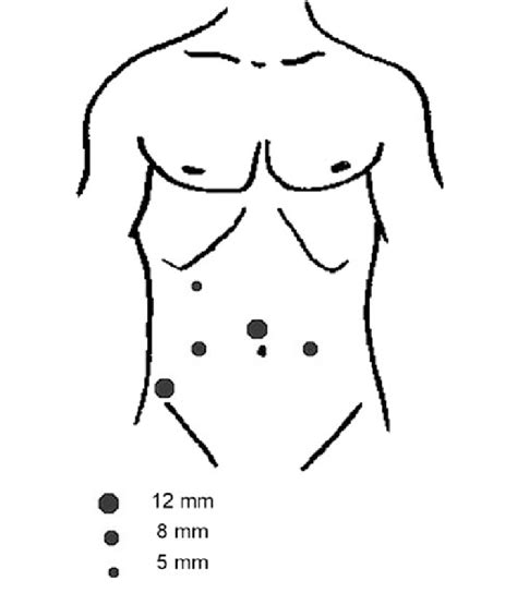 Schematic diagram of port placement | Download Scientific Diagram