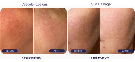 Ipl Photofacial Understanding Its Benefits And Effectiveness
