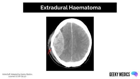 Types Of Intracranial Haemorrhage Bleeds Geeky Medics