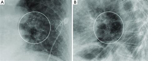 Cxr Pa A And Lateral B Views Showing The Ibvs In Place In The Lower