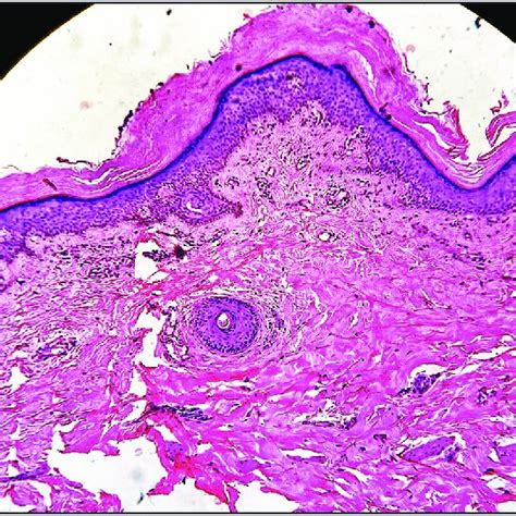 Histopathological Image Of Biopsy From Rash On Back Showing Compact