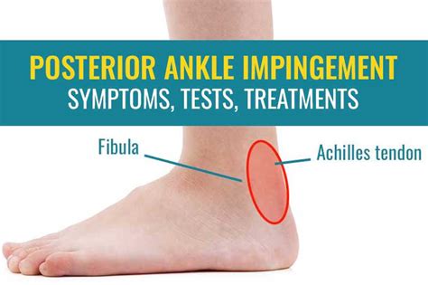 Posterior Ankle Impingement Symptoms Tests And Treatment