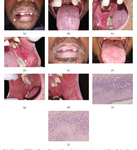 Figure 1 From A Case Series Of Psychological Stress Evaluation As A Risk Factor For Oral Lichen