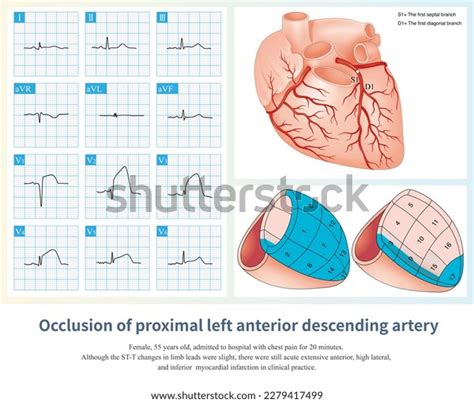 1 Ecg Inferior Anteroseptal Lateral Images, Stock Photos, 3D objects ...