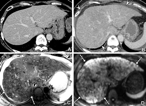 Liver Metastases Correlation Between Imaging Features And