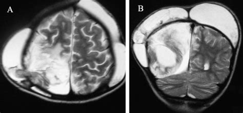 Posttraumatic Intraventricular Arachnoid Cyst Accompanied By