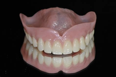 Full Dentures - Art Dental Lab