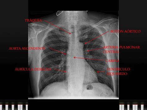 Radiologia Lleida Radiografia De Torax Iii Lectura Sistemática