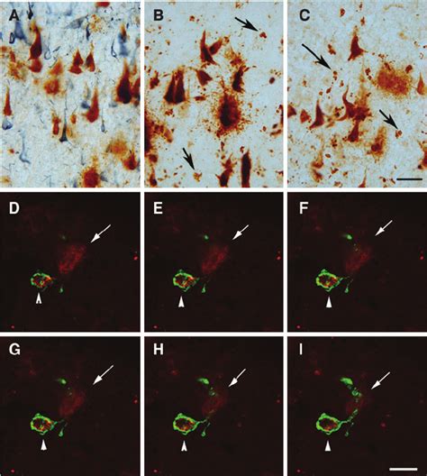 Tau And Beta Amyloid A B In A Case With Dementia Pugilistica Dp