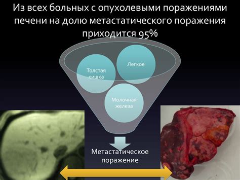 Первичные и вторичные опухолевые поражения печени Хирургия и таргетная ...