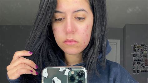 My ACCUTANE Journey Week 2 No Insurance Raw Footage YouTube