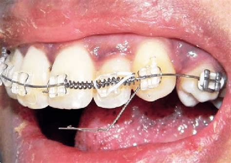 Tooth Engaged With Ligature Wire Download Scientific Diagram