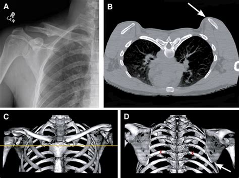 The Radiographic Quantification Of Scapular Malalignment After Malunion