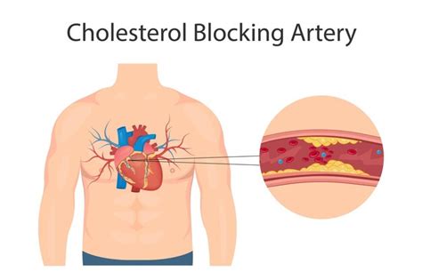 Premium Vector Atherosclerosis Concept Health Risk Human Heart