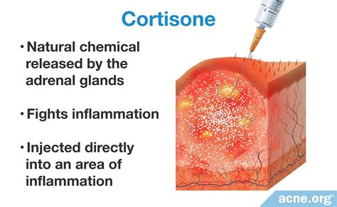 Cortisone Shots For Severe Acne Nodules And Cysts Acne Org