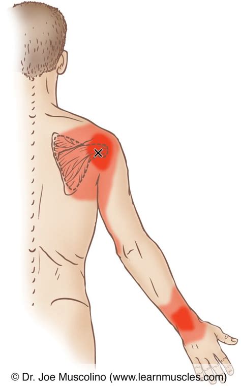 Supraspinatus Trigger Points